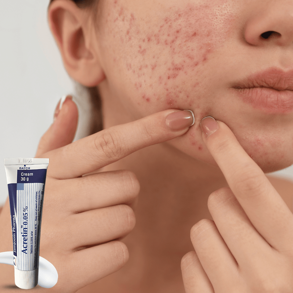 Look Alyfe Acretin Tretinoin 0.05% Acne Treatment Cream - 30g