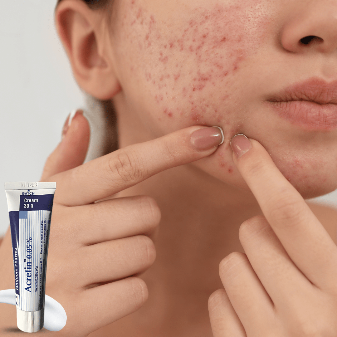 Look Alyfe Acretin Tretinoin 0.05% Acne Treatment Cream - 30g