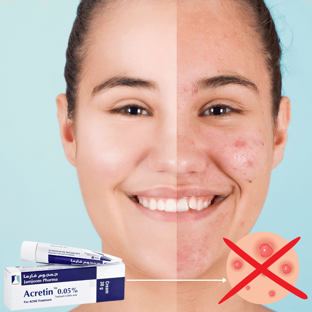 Look Alyfe Acretin Tretinoin 0.05% Acne Treatment Cream - 30g