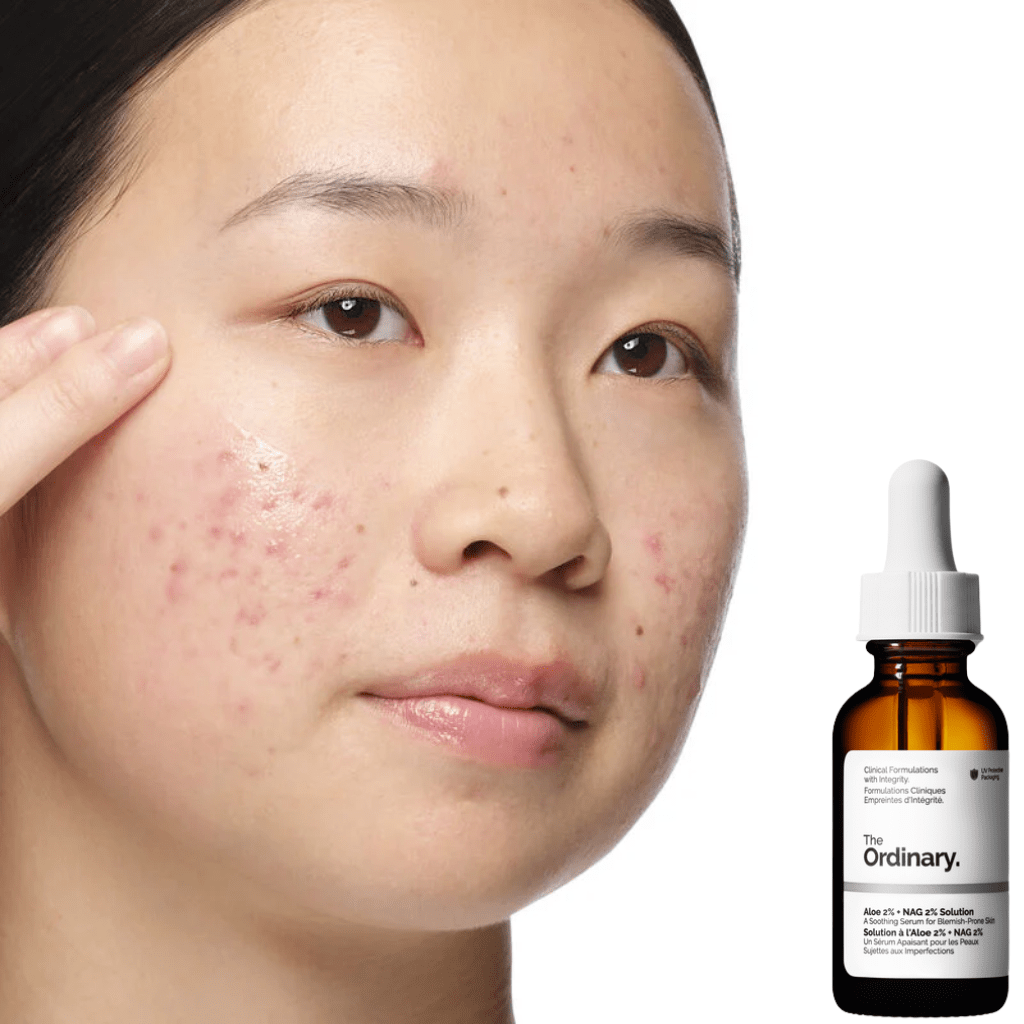 Look Alyfe The Ordinary Aloe 2% + NAG 2% Solution - 30ml